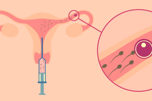 IVF - In Vitro Fertilization